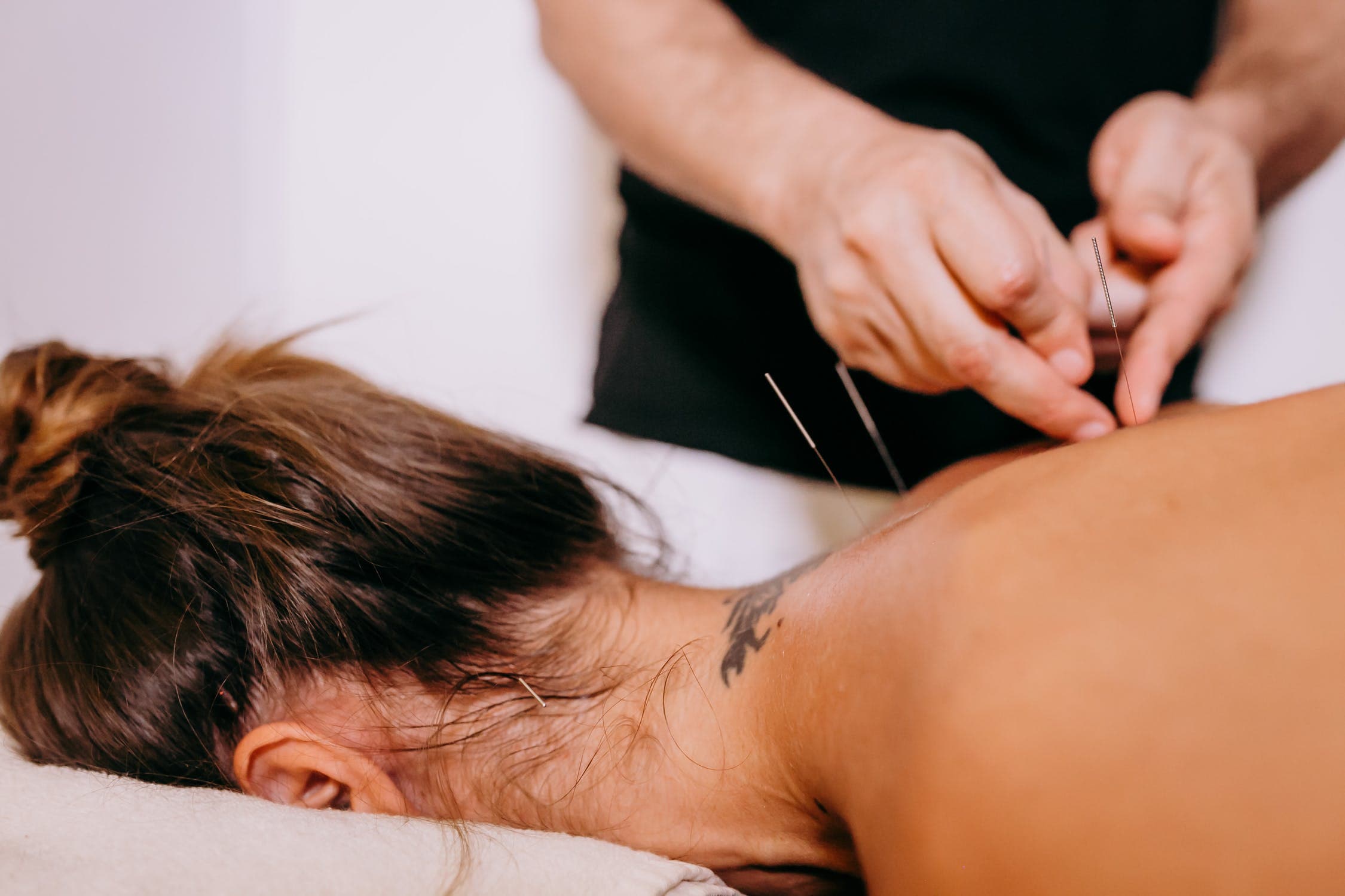 Acupuncture treatment